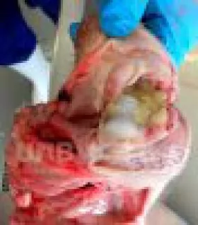 BỆNH GLASSER Ở LỢN (VIÊM ĐA XOANG)